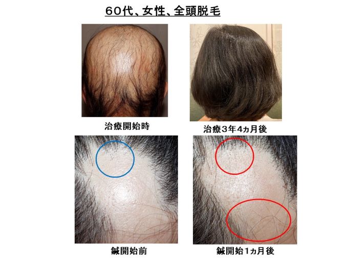 円形脱毛症　病院